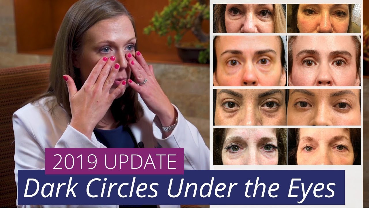 How to Treat Dark Circles Under the Eyes [2019 Update] #EyeBags #DarkCircles