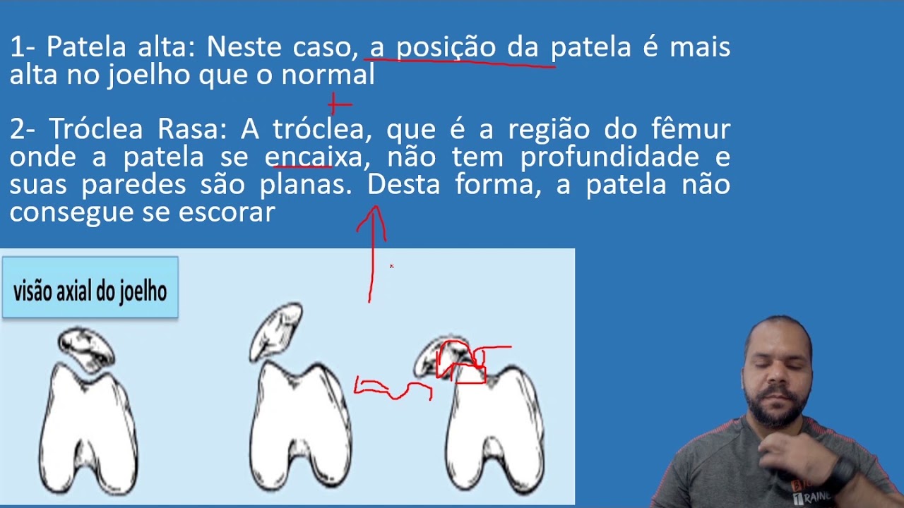 Biomecânica do Joelho: A lateralização da Patela