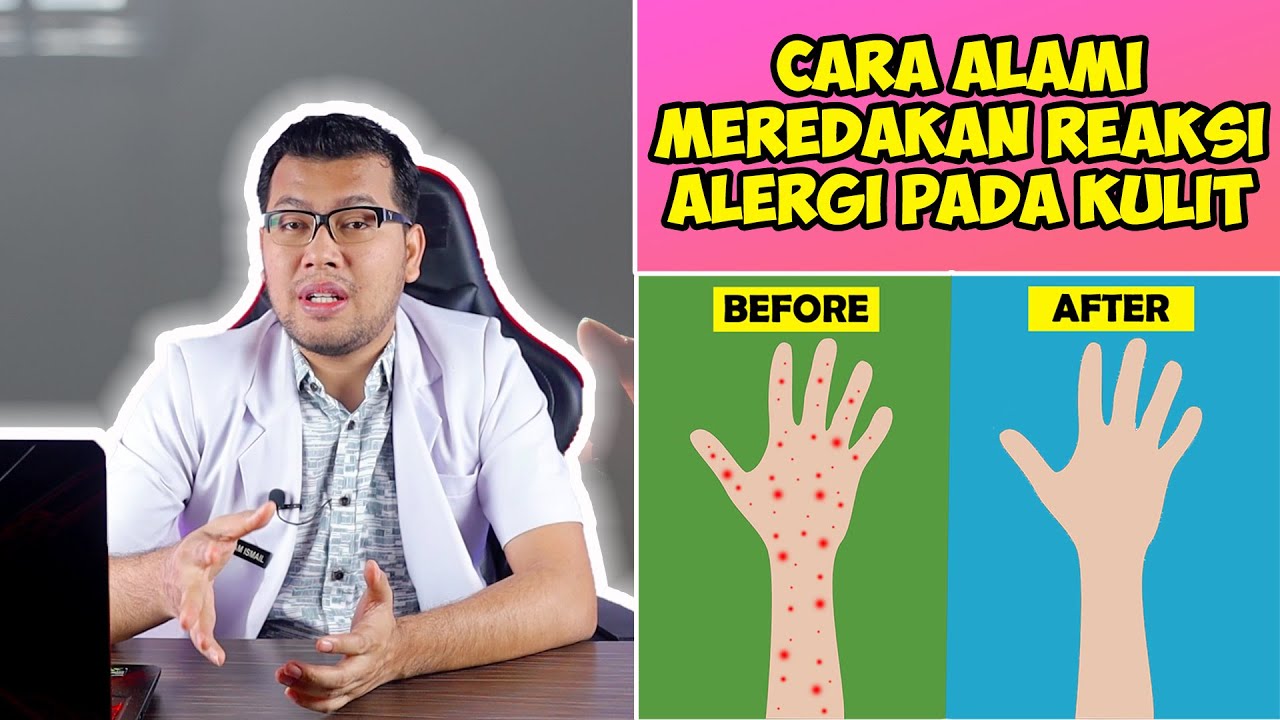 CARA ALAMI MEREDAKAN REAKSI ALERGI PADA KULIT - DOKTER SADDAM ISMAIL