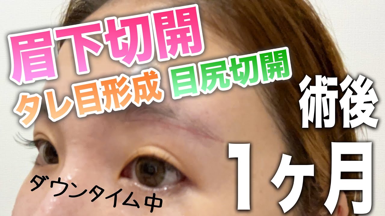 【整形後1ヶ月レポ】眉下切開・目尻切開・タレ目形成の傷跡は？！【ダウンタイム】