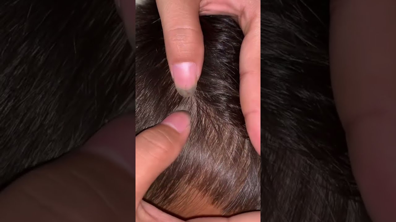 (Part 28) Lice Removal & Treatment Satisfying | Lice Popping