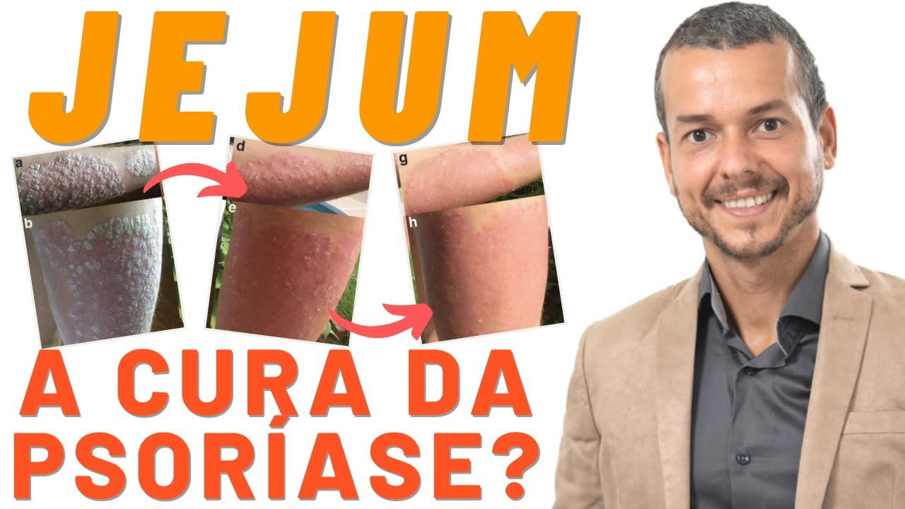 JEJUM CURA PSORI&Aacute;SE? Tratamento Natural de Doen&ccedil;as Autoimunes
