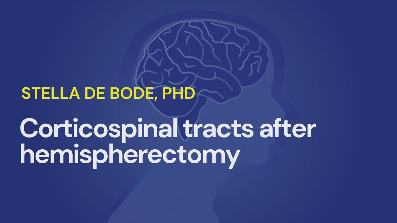 CORTICOSPINAL TRACTS AFTER HEMISPHERECTOMY, GAIT TRAINING, AND CIMT V. HAND ARM BIMANUAL TRAINING