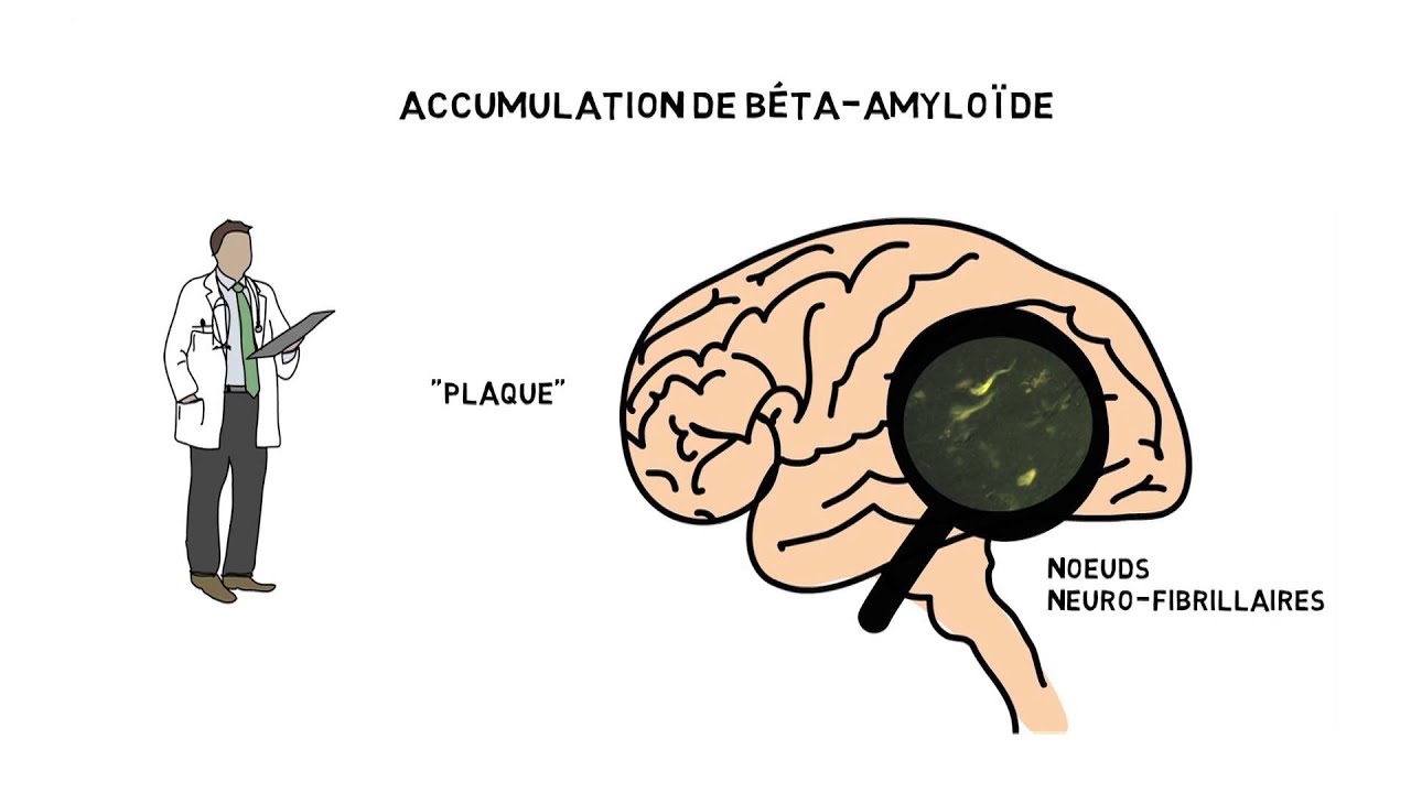 Maladie d'Alzheimer: les causes de la maladie