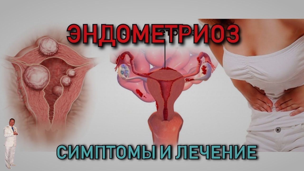 Эндометриоз.  Симптомы и лечение.
