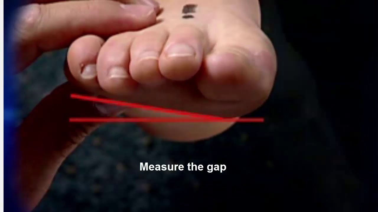 Assessing Forefoot valgus measurement