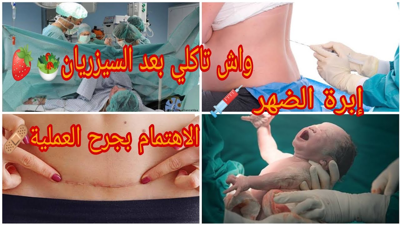 نصائح بعد العملية القيصرية 🧑‍🍼 سيزاريان لأول مرة