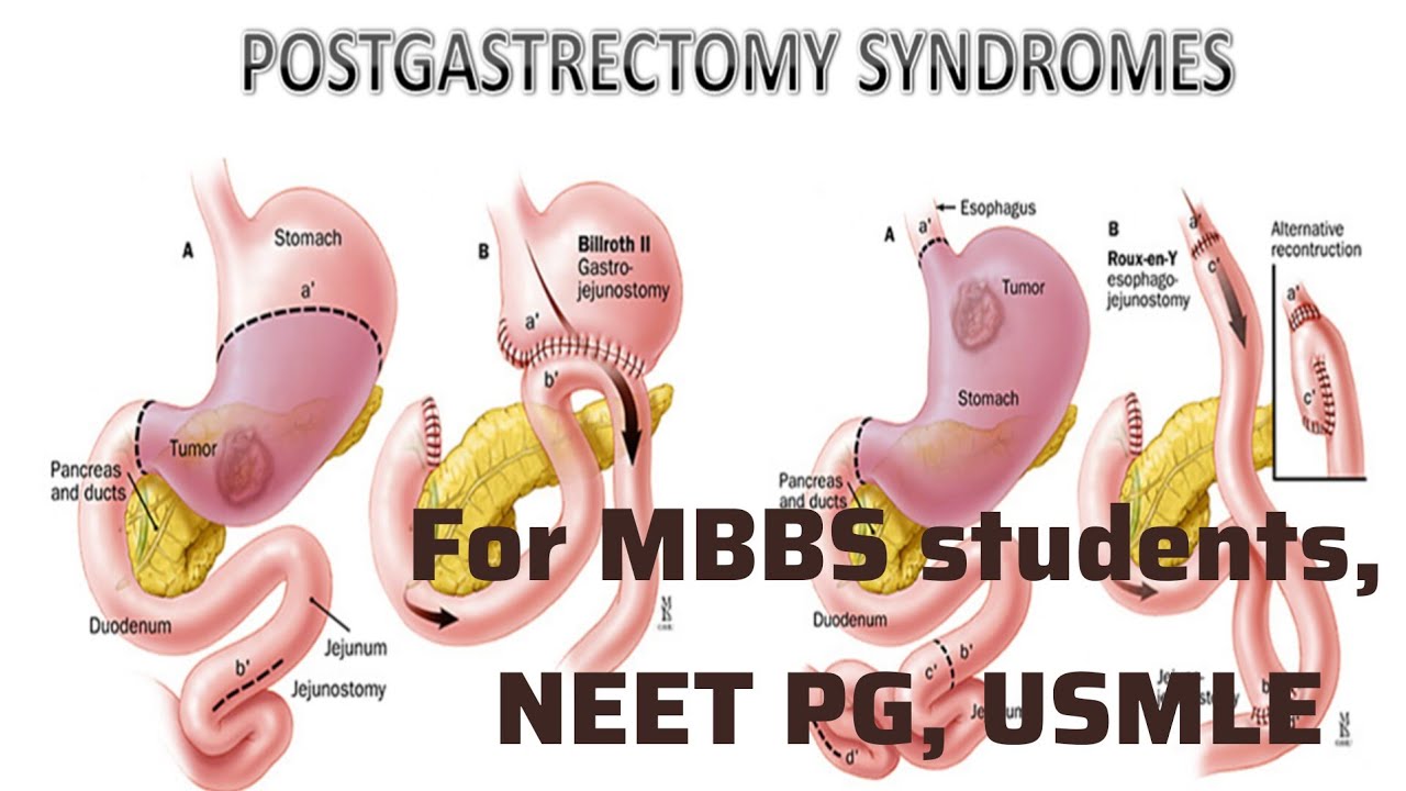 Осложнения гастрэктомии для студентов MBBS, Neet PG, Usmle I NeetPG Usmle Подготовка