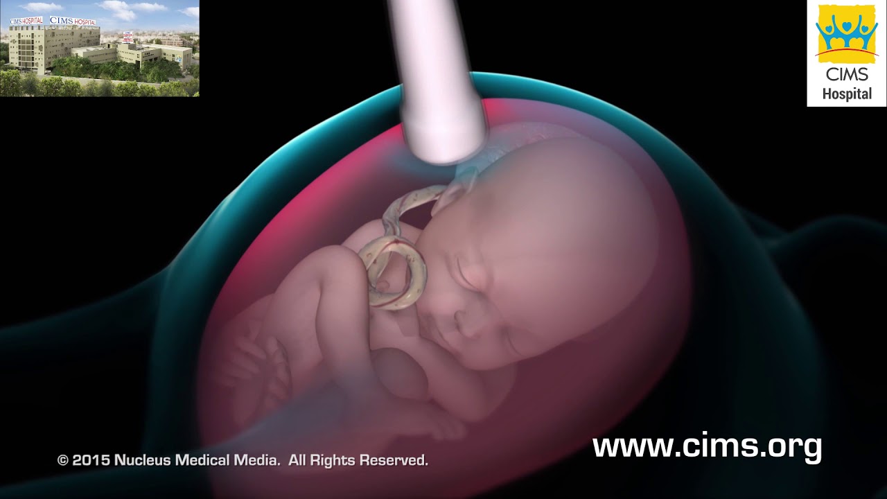 Amniocentesis (Gujarati) - CIMS Hospital