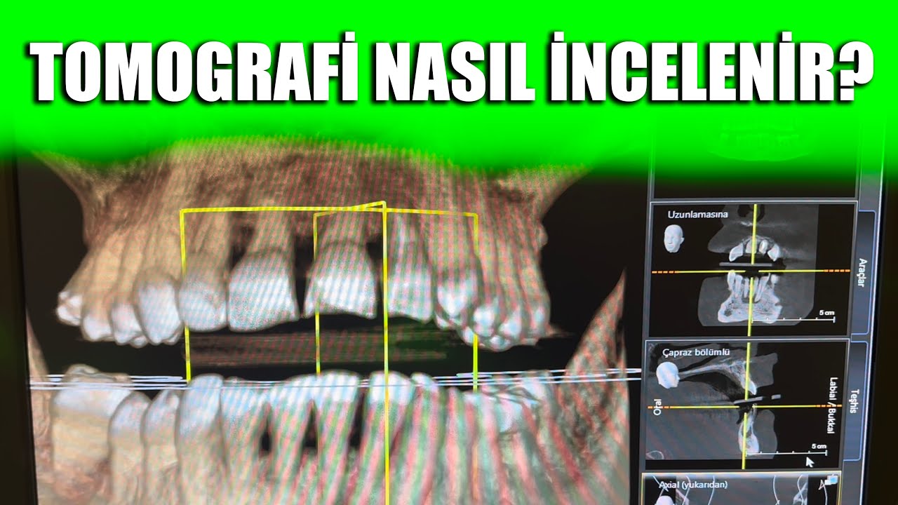 Diş Sağlığında 3D Tomografi Ne İşe Yarıyor?