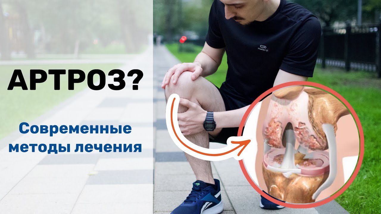Артроз, остеоартроз, гонартроз. Лучший способ лечения.