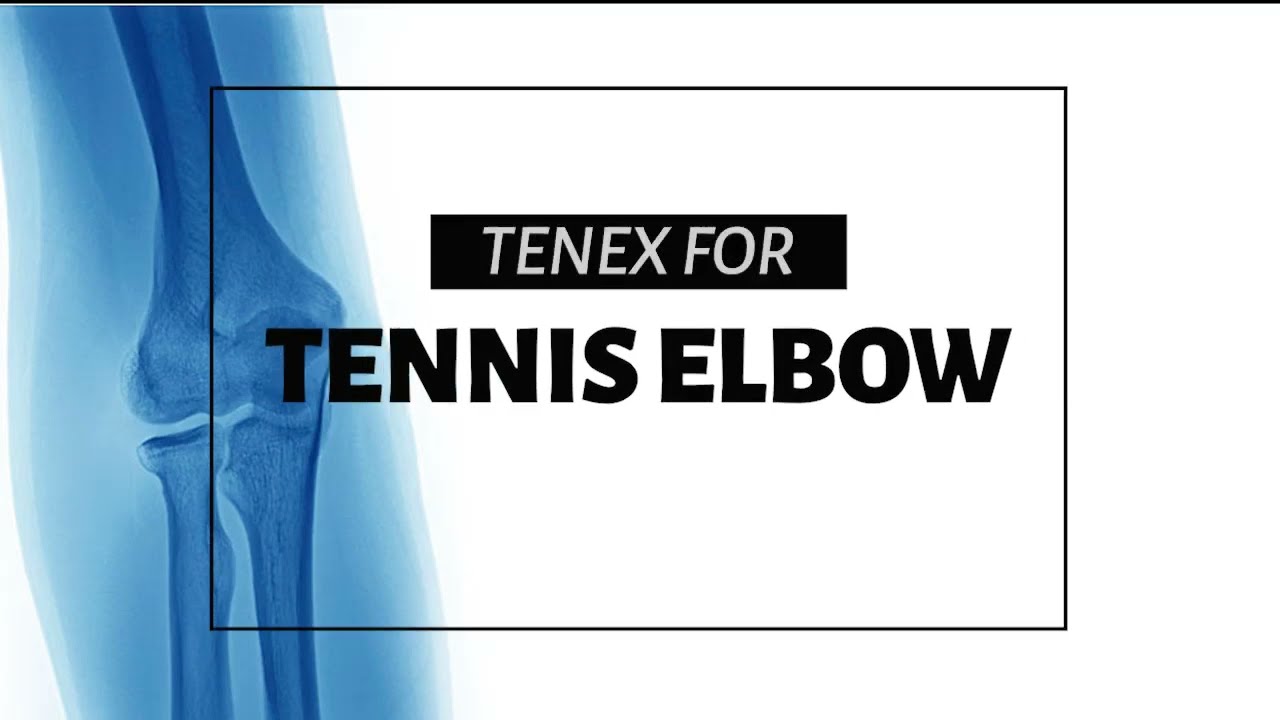 Minimally Invasive Tenex Tenotomy for Tennis Elbow &ndash; No General Anesthesia Needed!