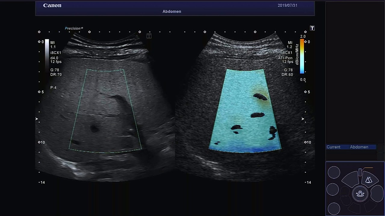 ATI Liver Steatosis - Canon Medical Systems