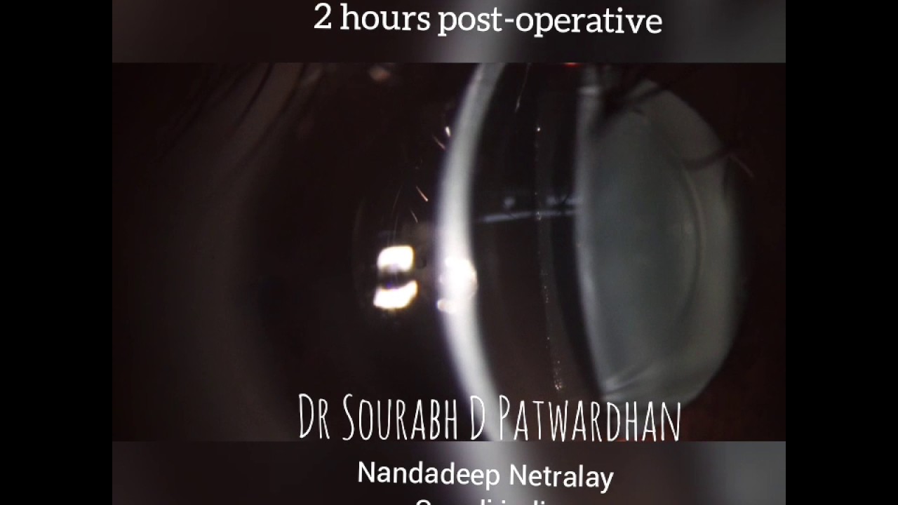 Advanced technique of implanting Toric EyePCL (IPCL) Phakic IOL  by D Sourabh D Patwardhan