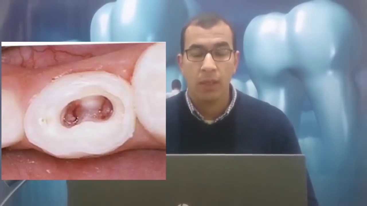 البيدو pulpotomy ولا pulpectomy