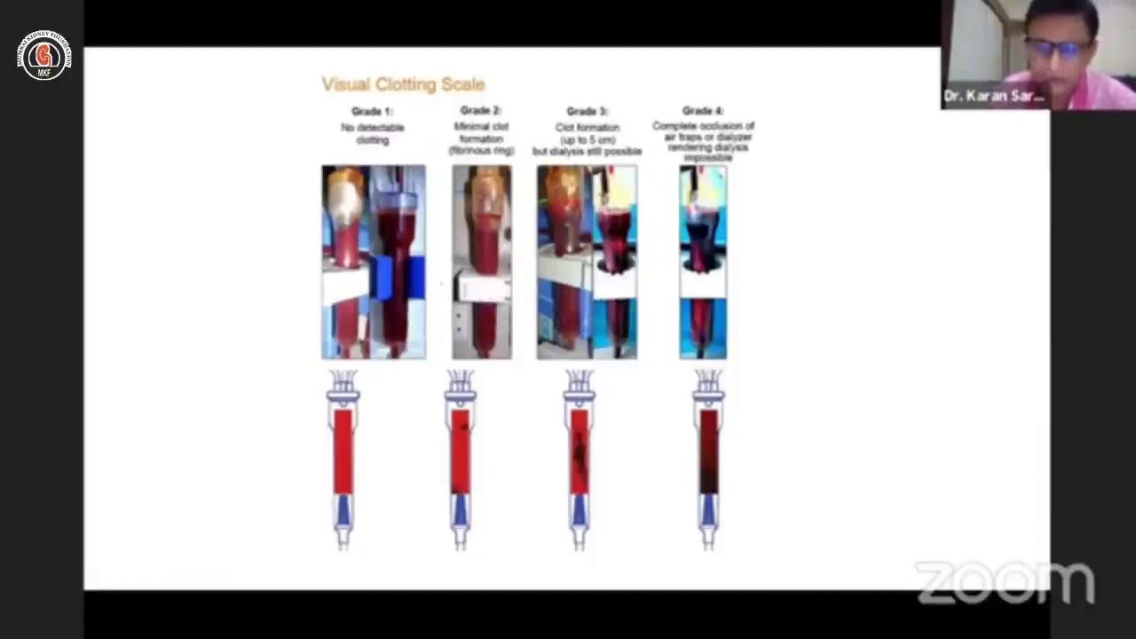 Anticoagulation in Hemodialysis by Dr Karan Saraf