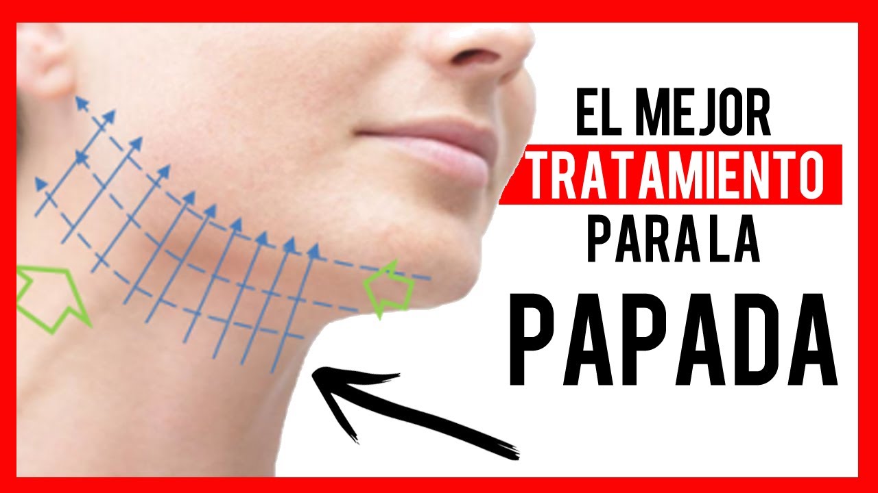 ✅ LIFTING en la PAPADA ((Con HILOS TENSORES))