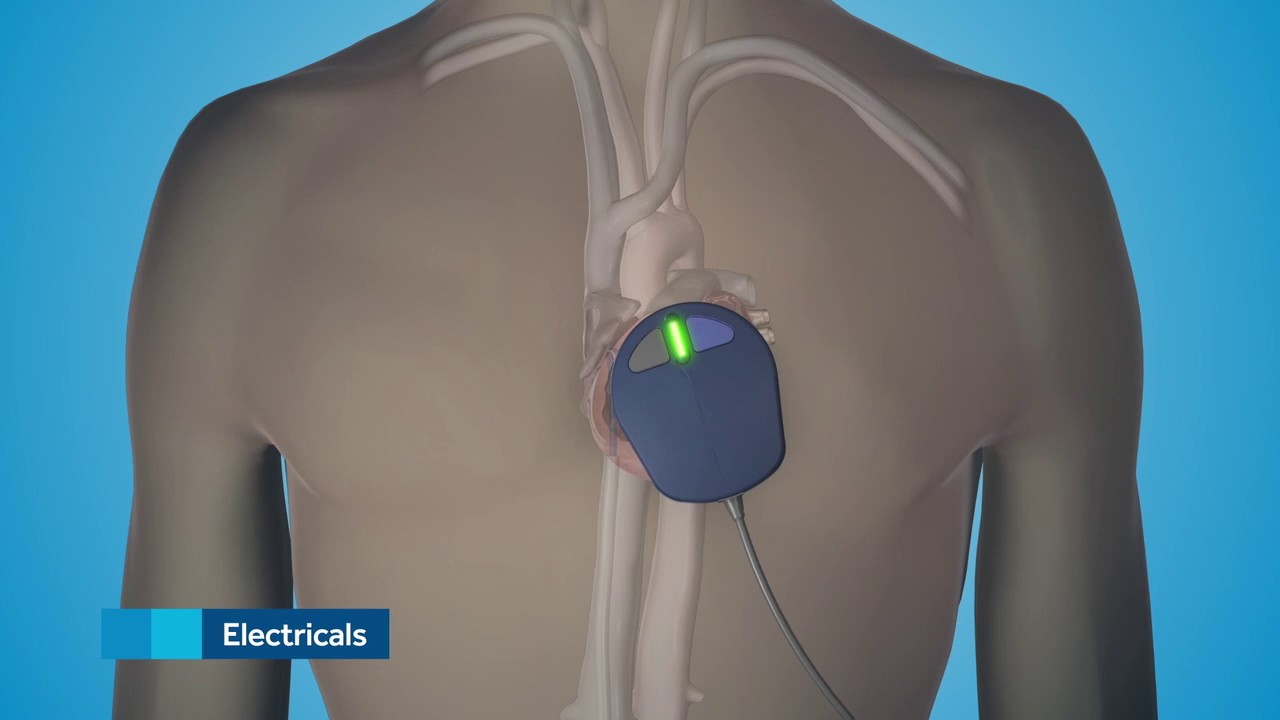 Medtronic Micra Transcatheter Pacing System | CardioVisual