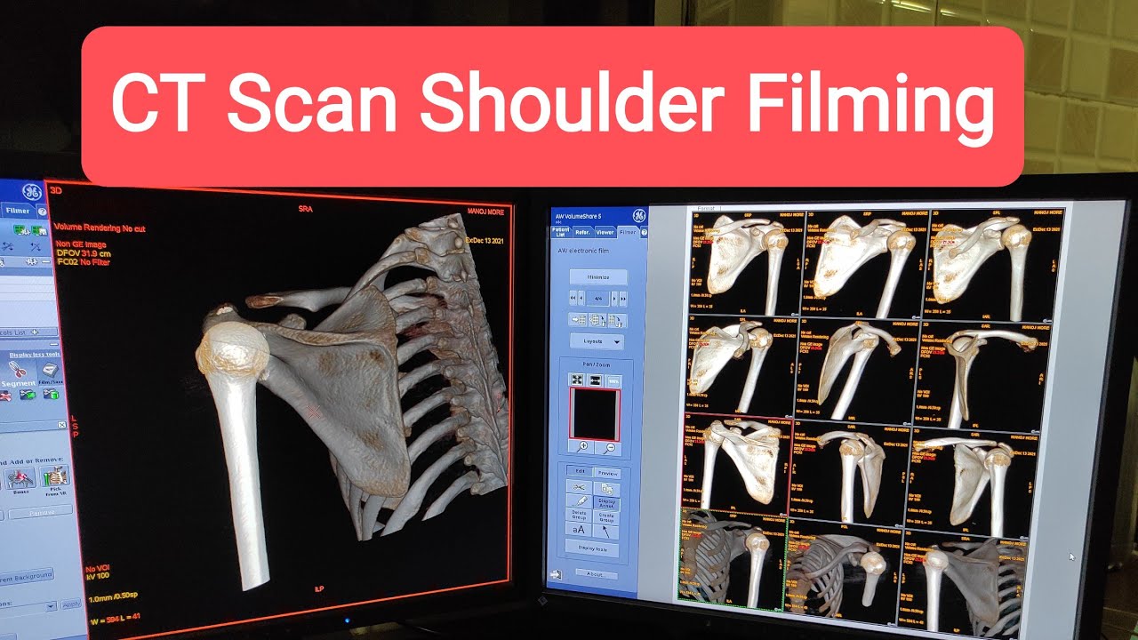 Shoulder CT scan Filming Protocol.