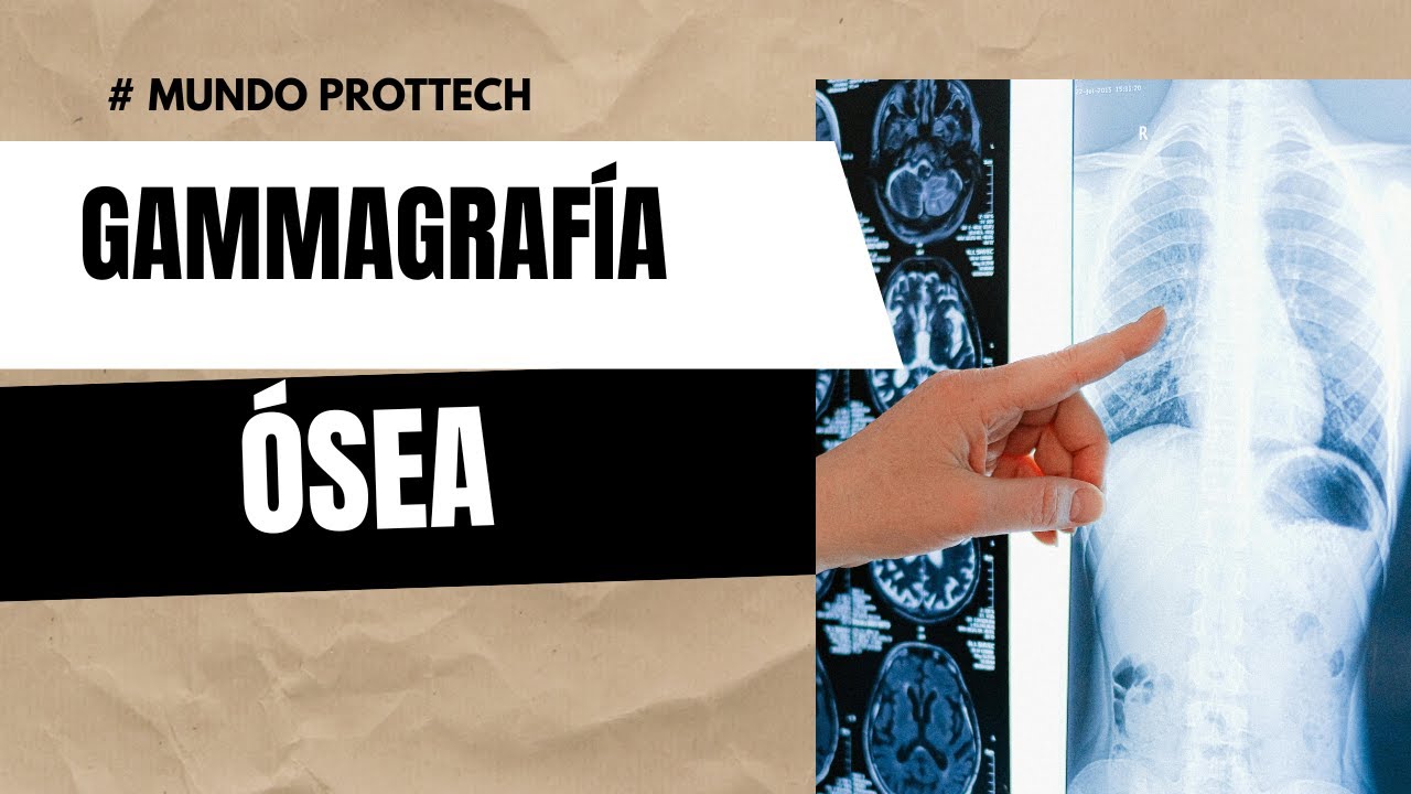 Gammagrafía ósea ‐ #Gammagrafía