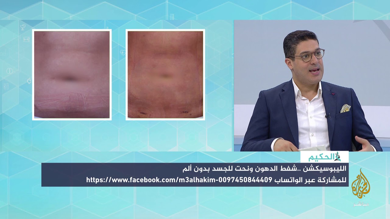 الليبوسيكشن…شفط الدهون بدون ألم!