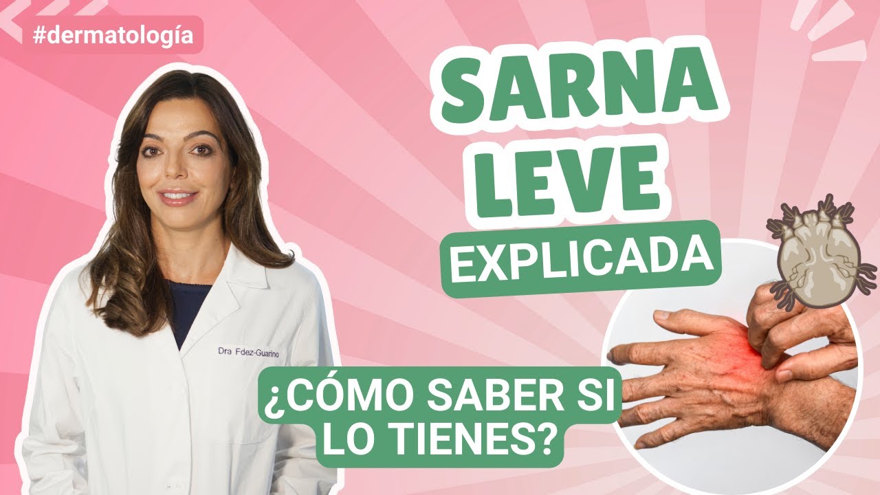 ¿Cómo saber si tienes Sarna?