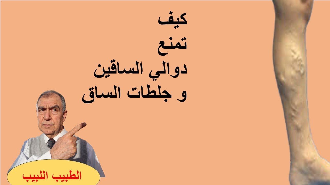 كيف تمنع دوالي الساقين وجلطات الساق