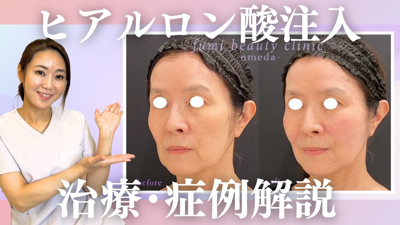 【ヒアルロン酸注入徹底解説】60代女性の方の症例写真とともにメリットやリスク、ふみ先生のヒアルロン酸治療のこだわりをお伝えします！