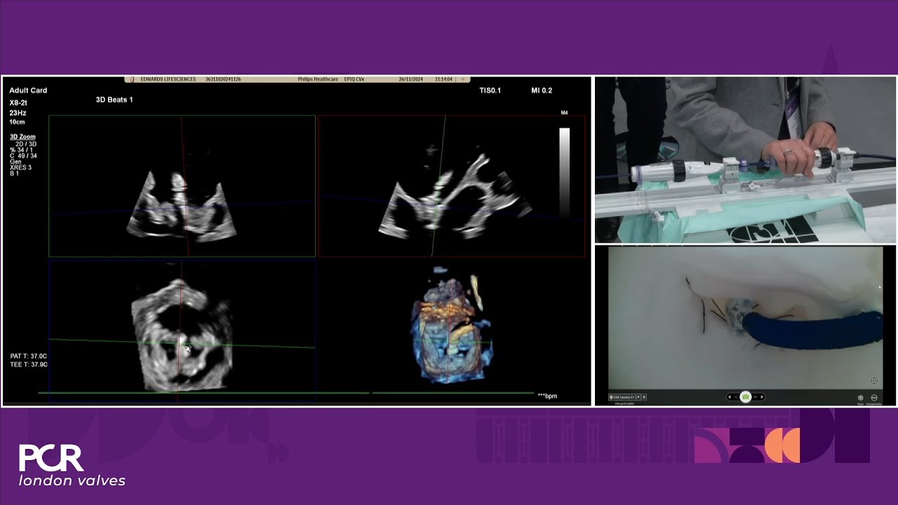 Transforming interventional care for patients with mitral regurgitation - PCR London Valves 2024