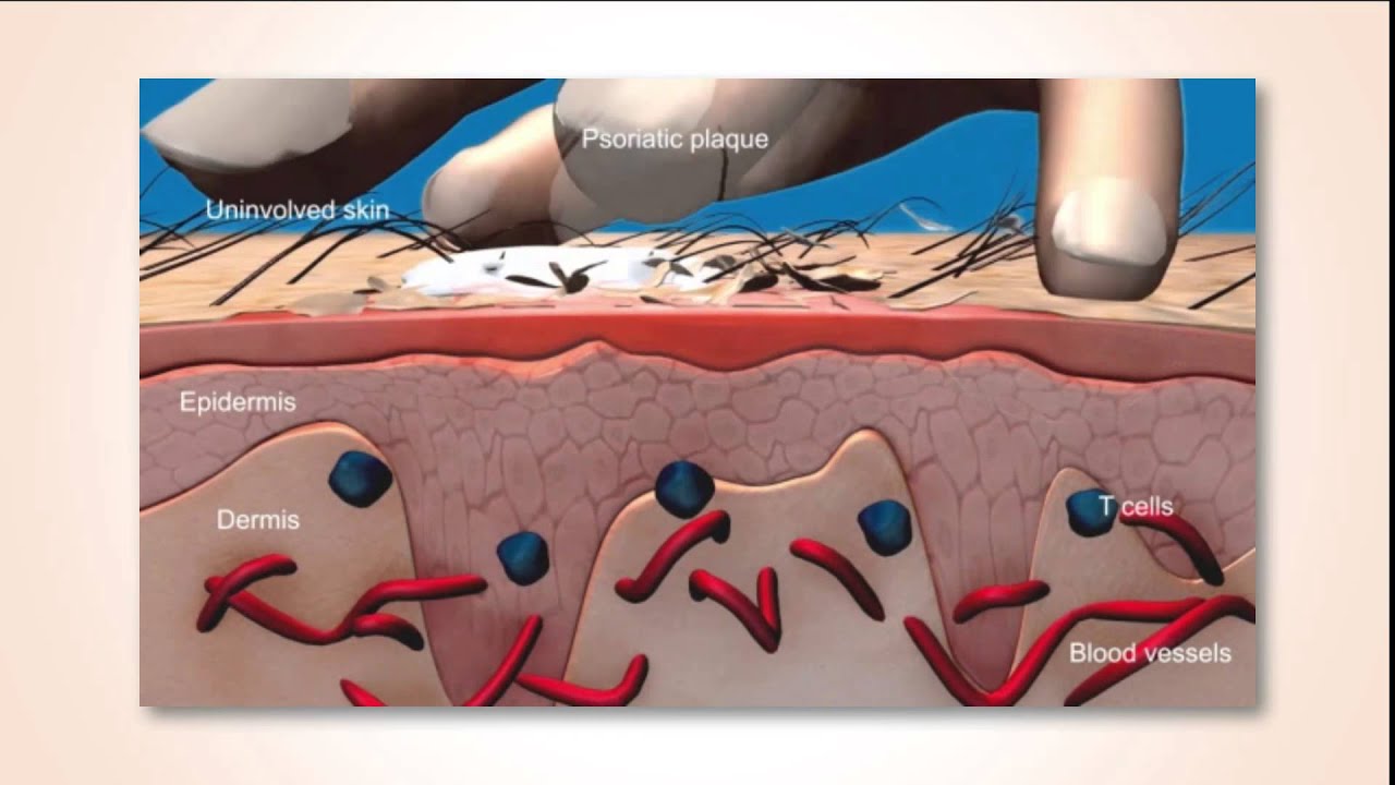Dermatologie Psoriasis voorlichting