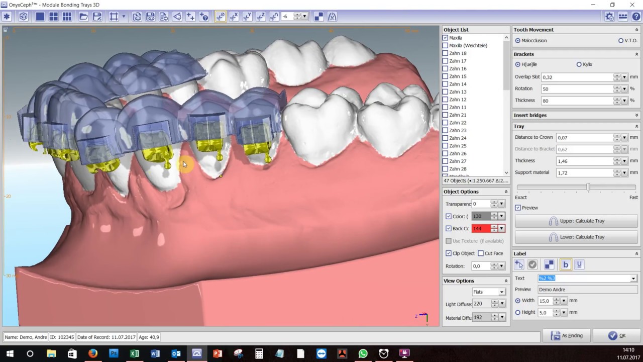 OnyxCeph³™ Module BondingTrays