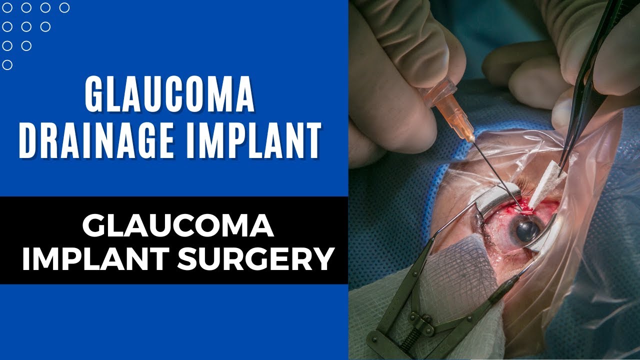 Glaucoma Drainage Implant | Glaucoma Implant Surgery (Animation) | Glaucoma Treatment