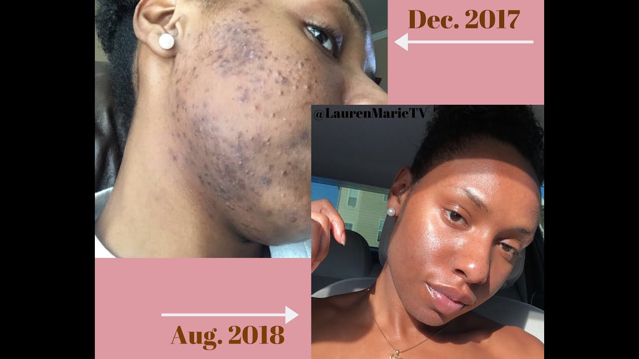 Hyperpigmentation acne: SECRET FORMULA Skin Care Routine