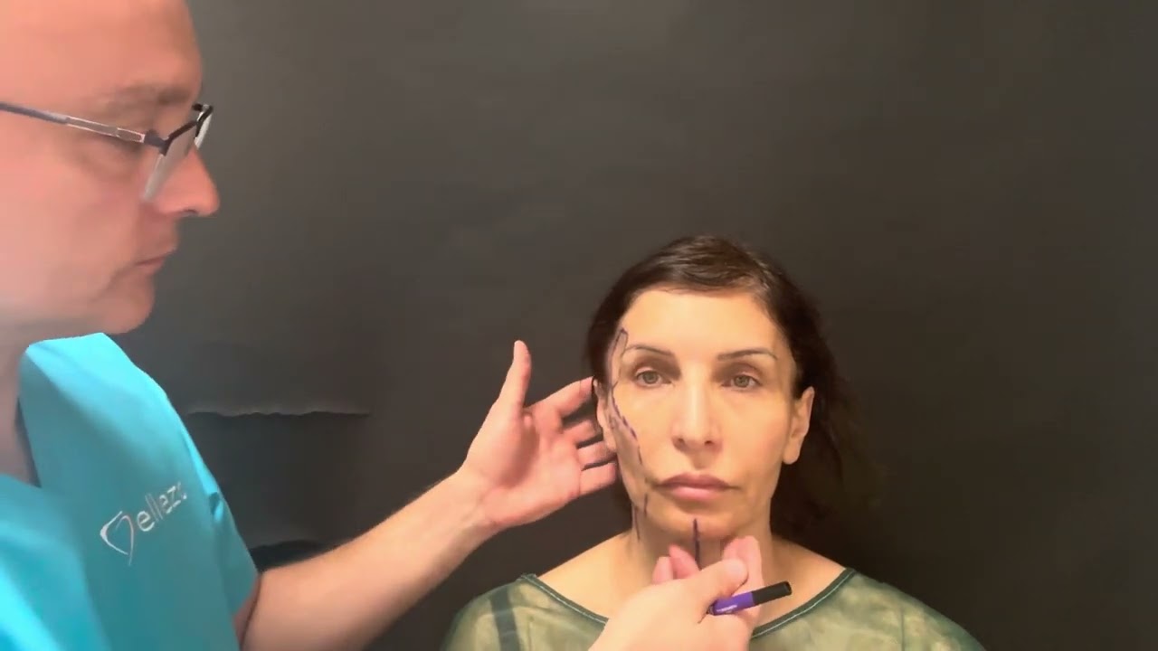 Facelifting (deep plane) v deň OP a 2 dni po. Dr. Zamboj