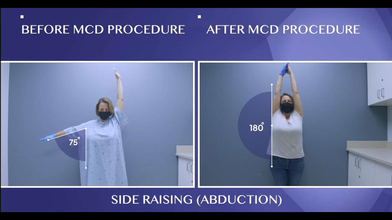 Frozen Shoulder Cured!