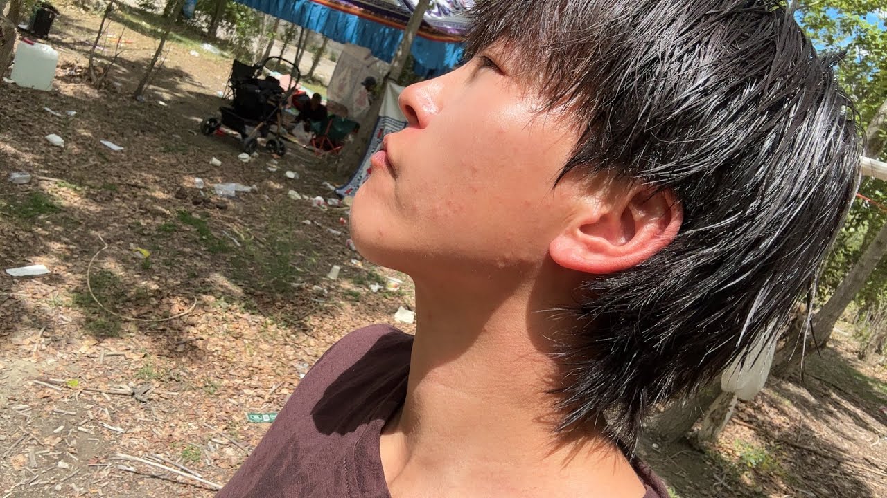 30岁女生还长青春痘吗？没成想骑行西藏毁容了