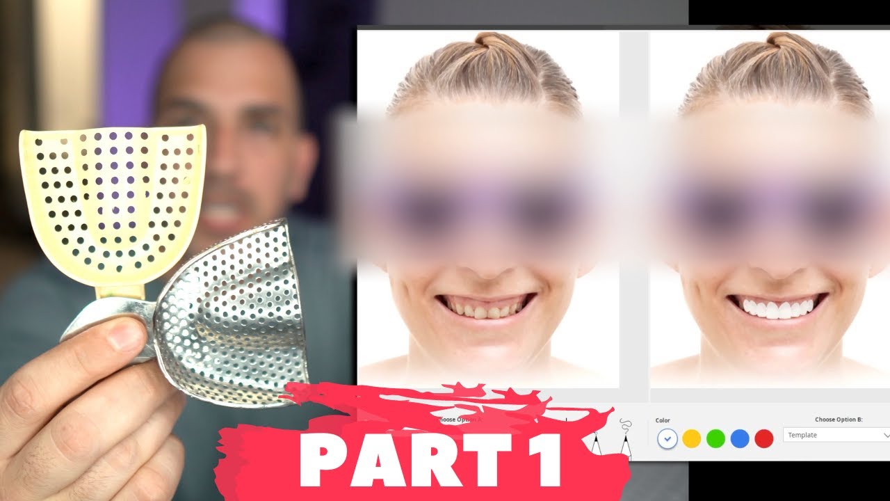 Porcelain Veneers Procedure | Digital Design App to Visualize Smile Makeover!