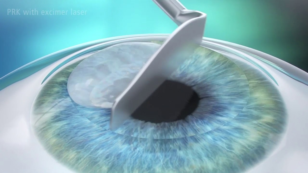 PRK vs. LASIK- What's the Difference?
