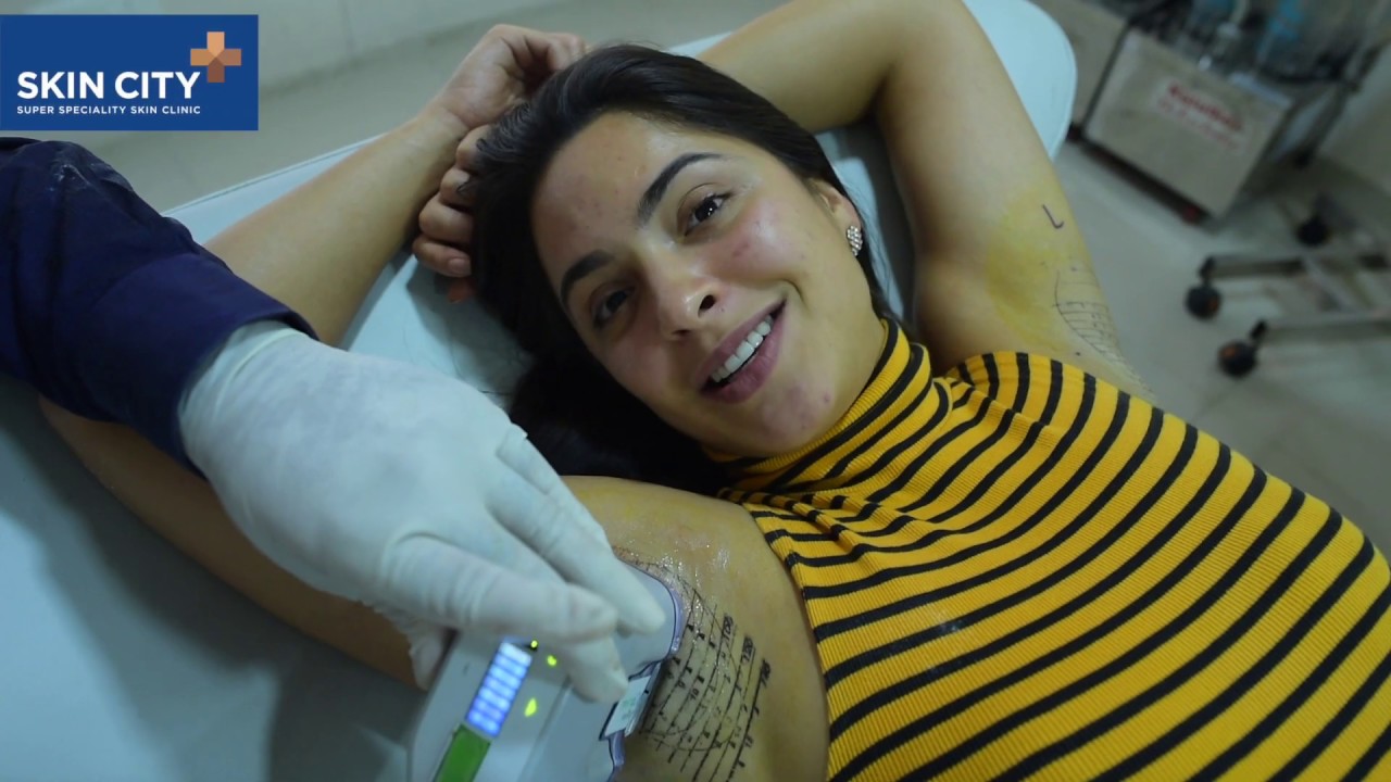 under arm sweat and odor gone forever I miradry I skincity I  Dhepe treats model Renata