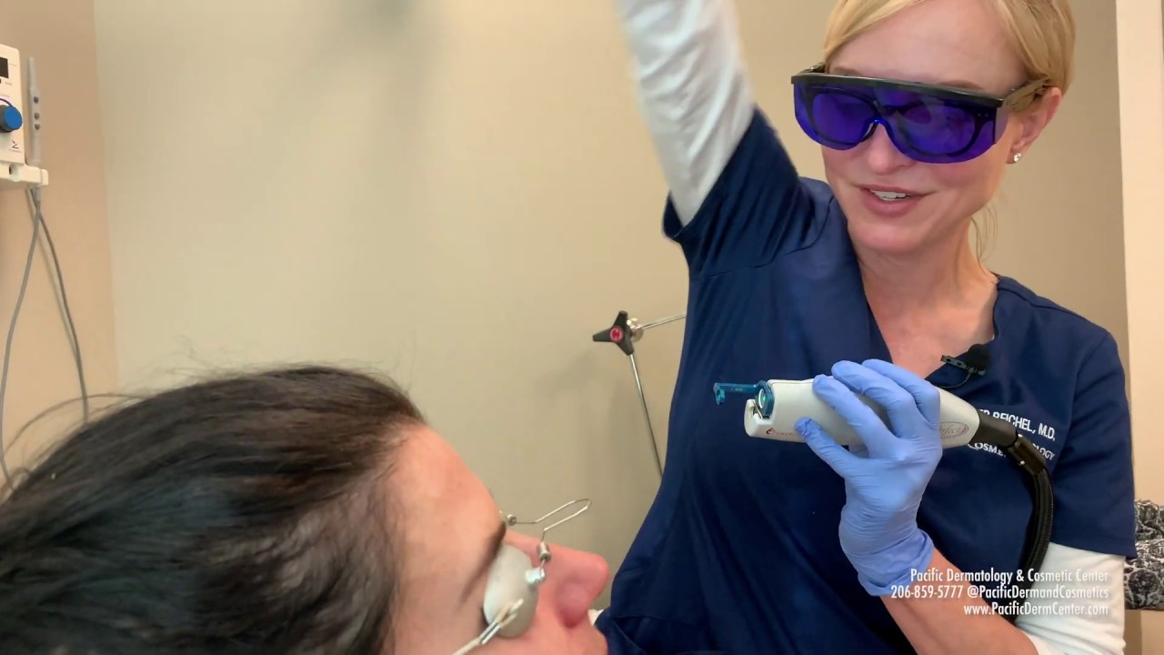 V Beam Laser for Broken Blood Vessels on The Face