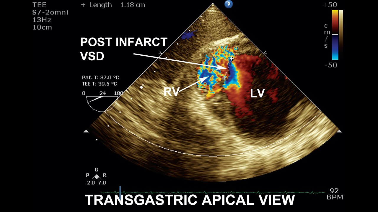 Apical VSD ? Hey...where is it ? I cannot find it on TEE !!!