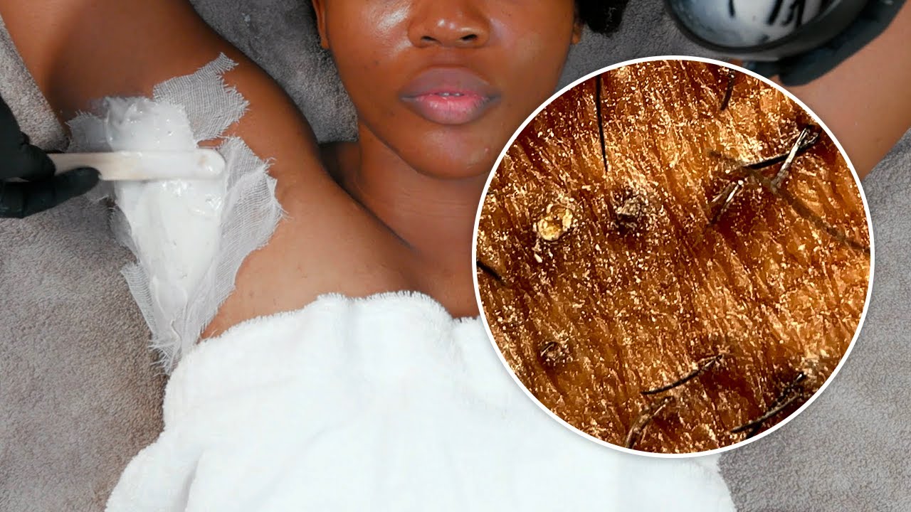 EXTREMELY SATISFYING Underarm Skincare - Ingrown Hair