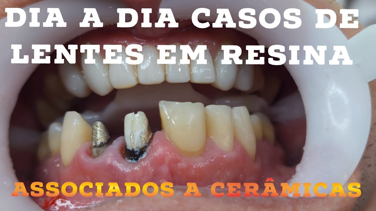 🛑DIA A DIA DE CASOS COMPLEXOS🤯🤩 REABILITAÇÕES COM LENTES EM RESINA ASSOCIADO A CERÂMICAS! 🔥