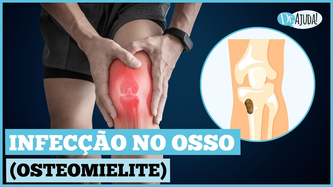 INFECÇÃO NO OSSO (OSTEOMIELITE): QUAIS OS SINTOMAS? O QUE FAZER?