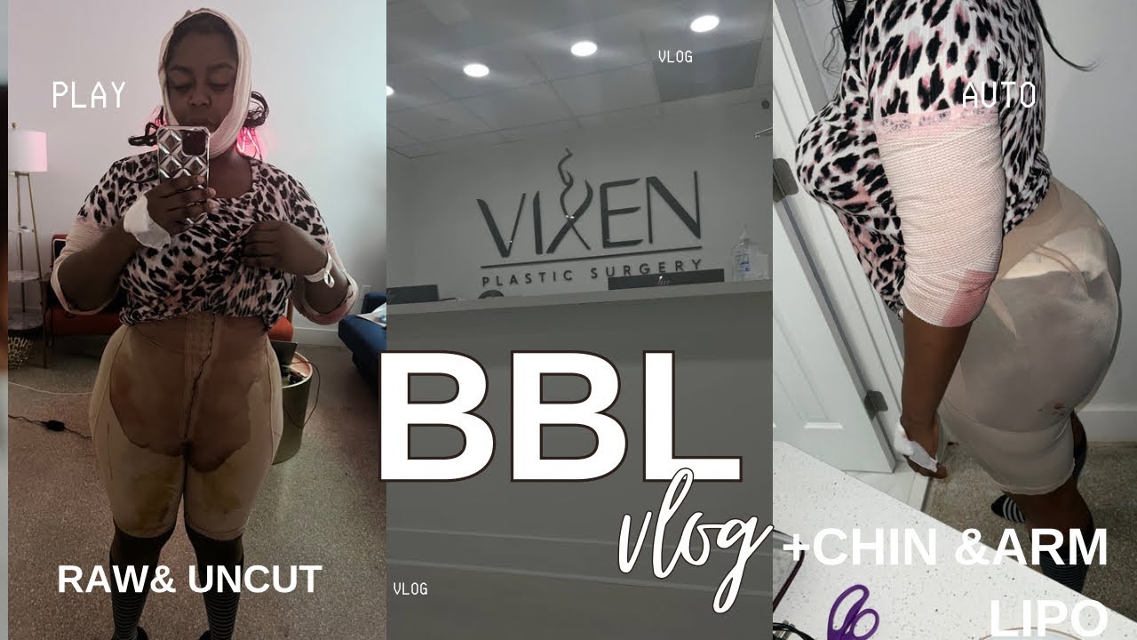 VLOG:FLEW OUT FOR A BBL+ Vixen Plastic Surgery