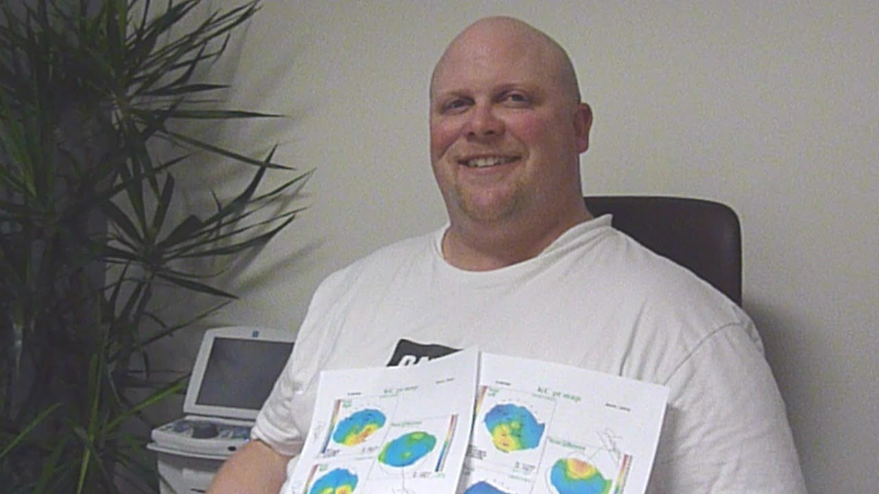 Dan Had Epi-Off Cross-linking on one eye & Holcomb C3-R Cross-linking in the other for Keratoconus