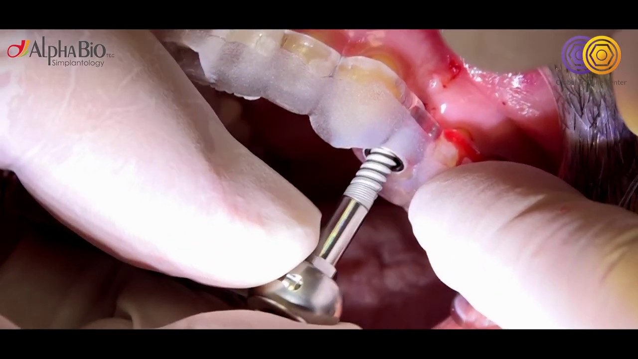 Guided implant surgery | Alpha-Bio Tec