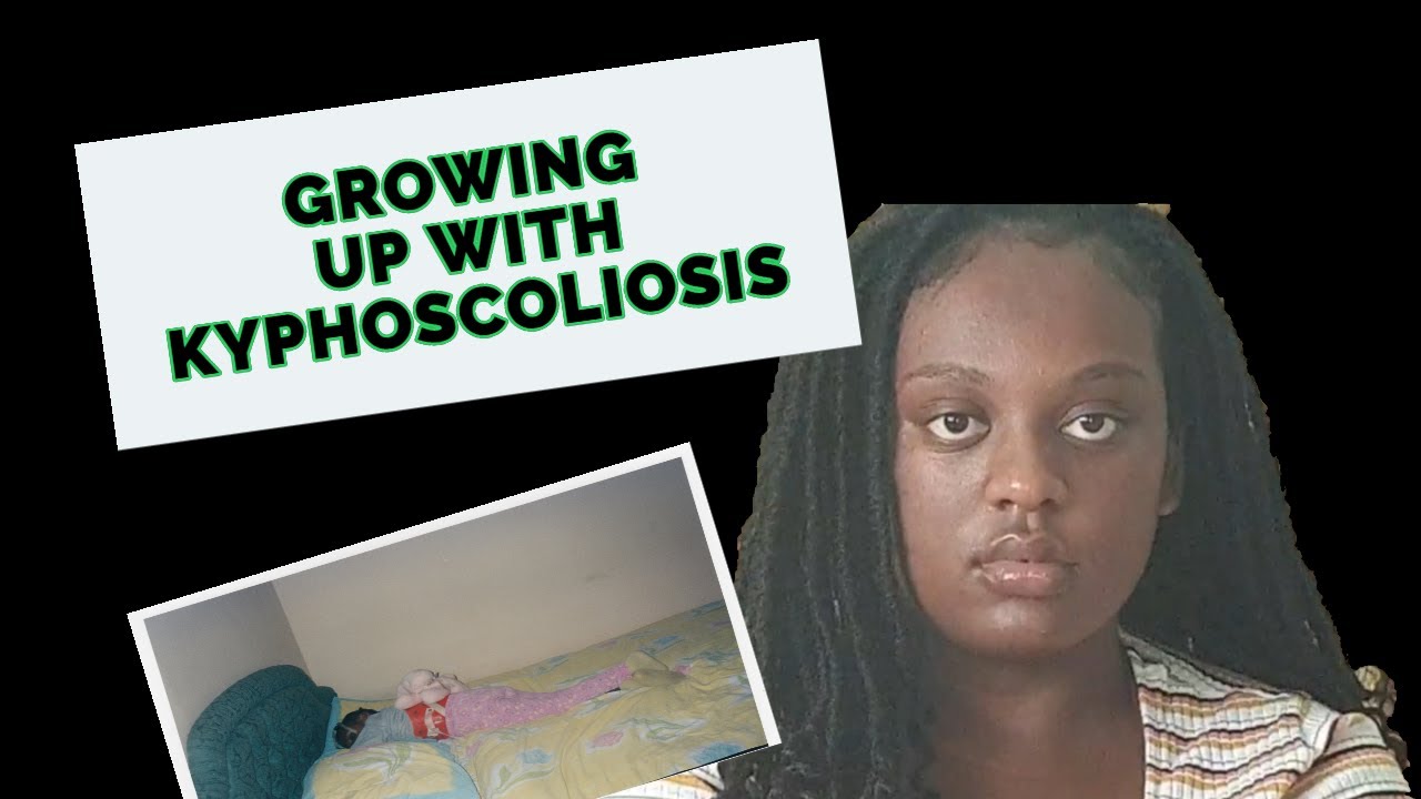 GROWING UP W/ KYPHOSCOLIOSIS | SCOLIOSIS AWARENESS MONTH