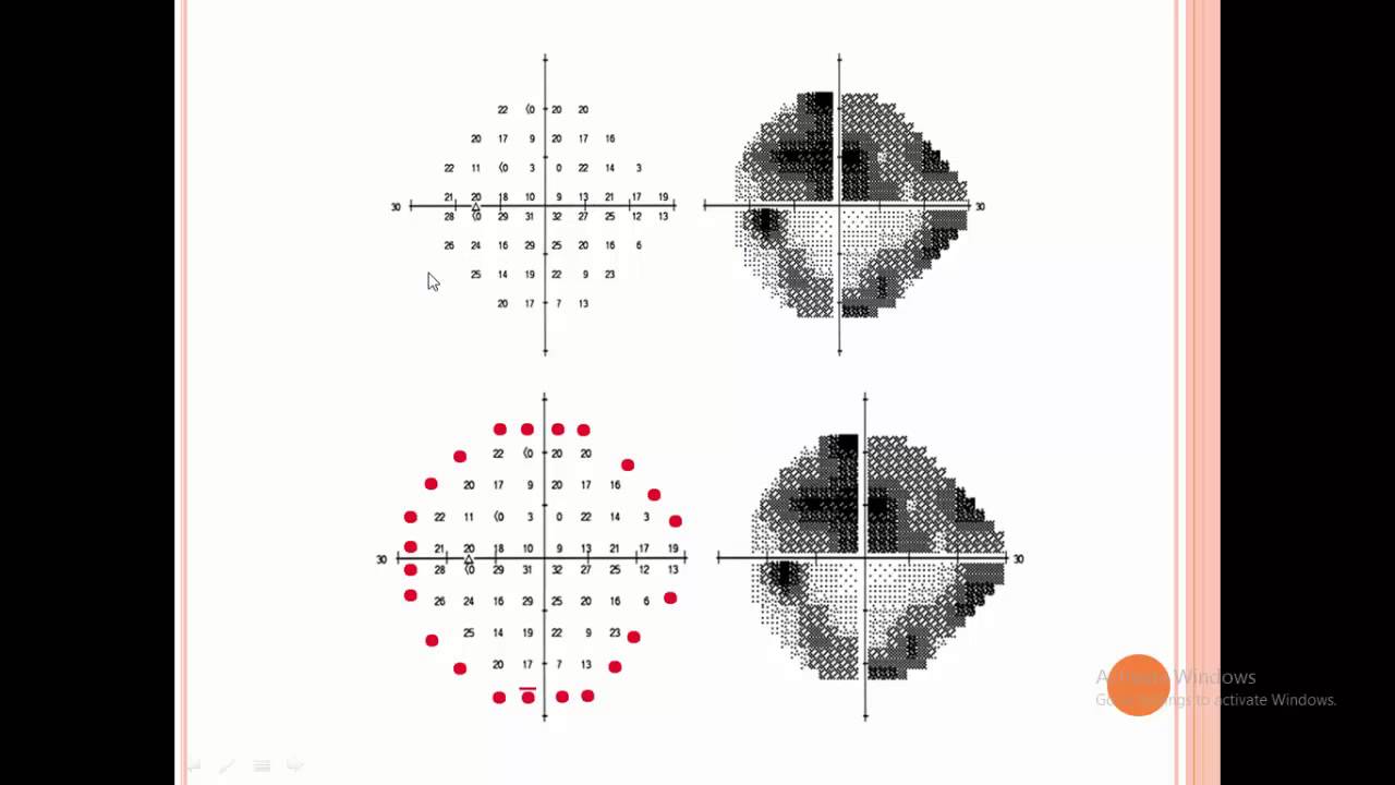 Visual Field