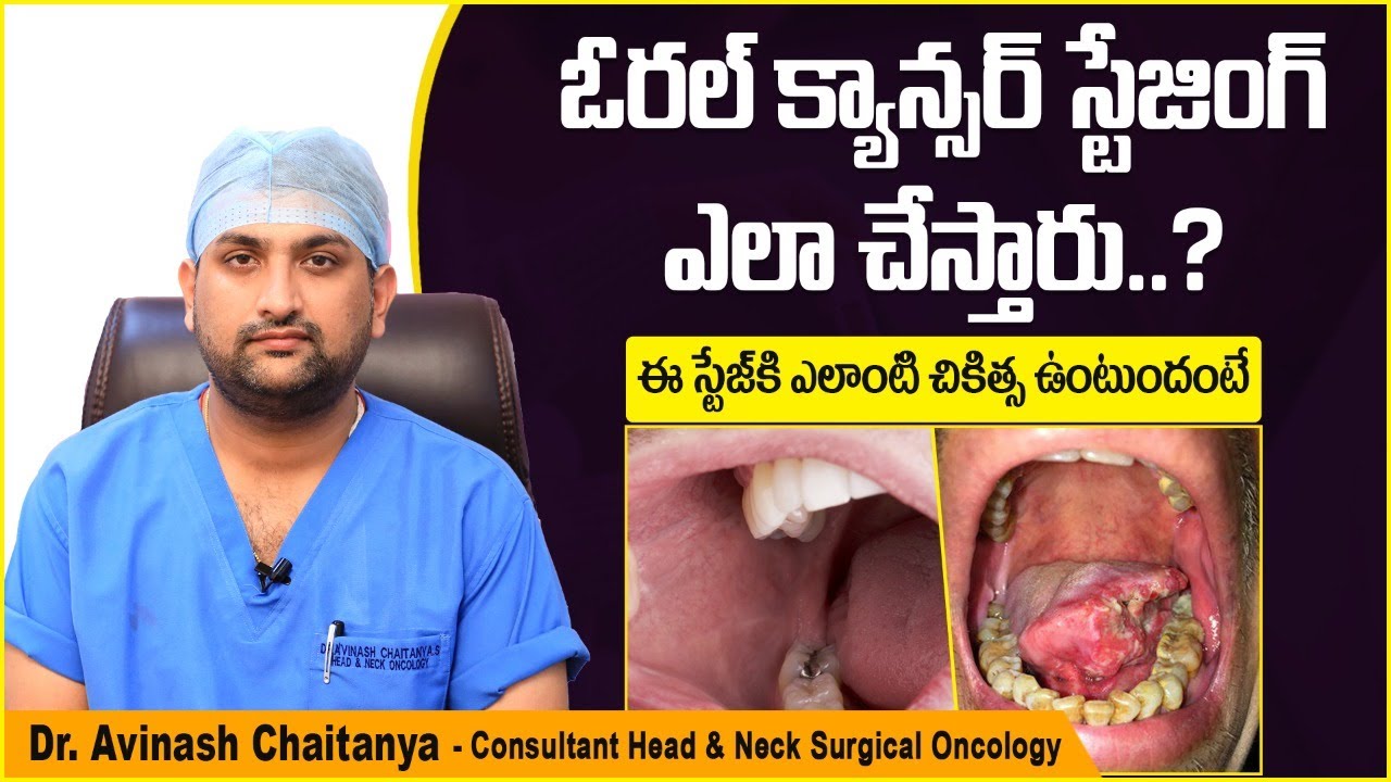 నోటి క్యాన్సర్ | Stages of Oral Cancer | Oral Cancer Treatment in Telugu | Kaizen Oncology Network